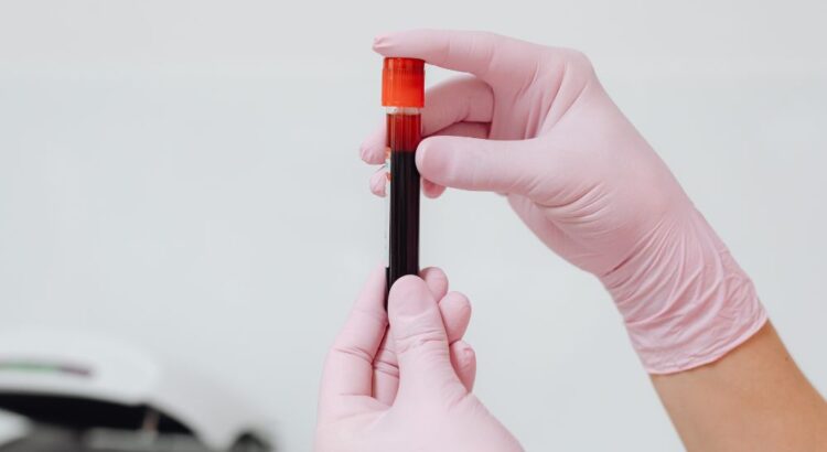Profissional da saúde segurando tubo de coleta de sangue para exame laboratorial, procedimento utilizado na avaliação da insuficiência venosa crônica.